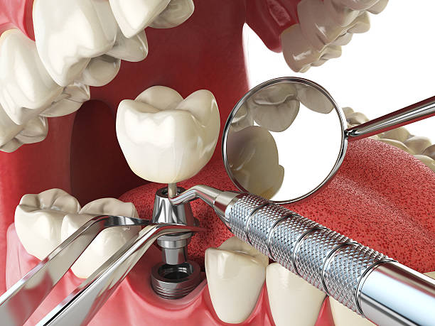 Best Emergency Tooth Extraction in Triana, AL
